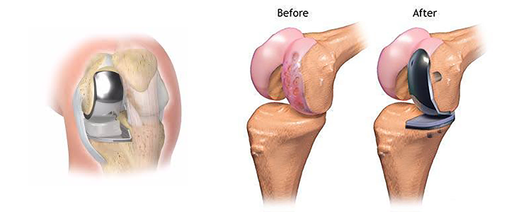 تعویض مفصل زانو ناکامل
