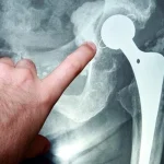 آرتروسکوپی لگن و نحوه انجام آن