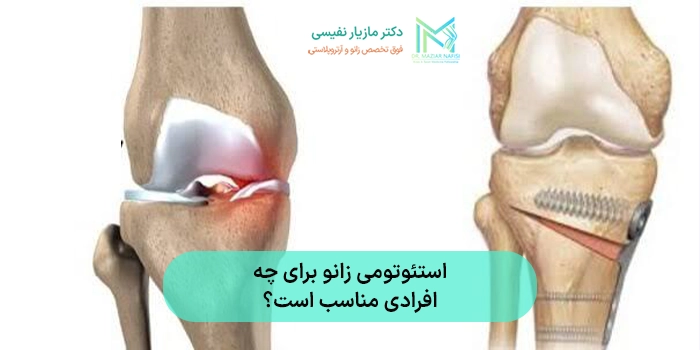 استئوتومی زانو برای چه افرادی مناسب است؟ راهنمای کامل جراحی