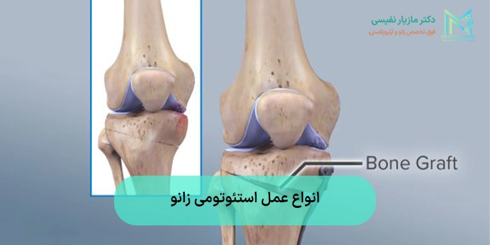 انواع عمل استئوتومی زانو
