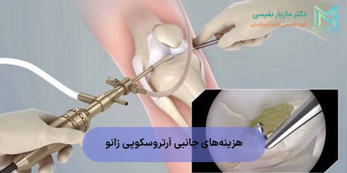هزینههای جانبی آرتروسکوپی زانو