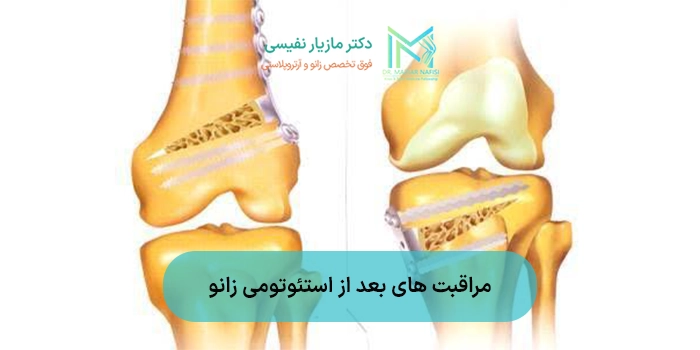مراقبت های بعد از استئوتومی زانو + نکات مهم و ضروری