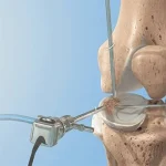 هزینه جراحی مینیسک زانو در سال 1405